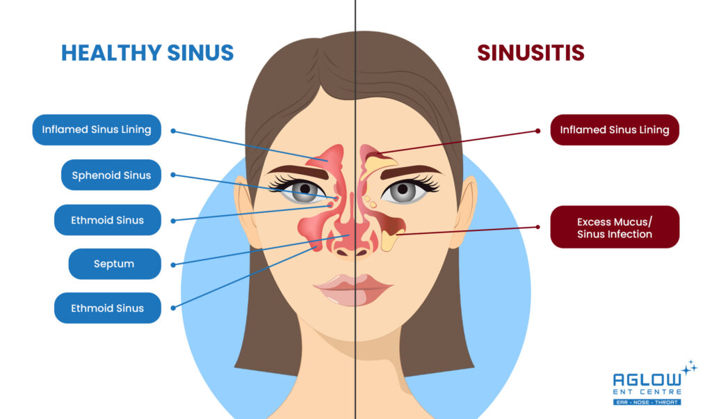 Comparison of a Healthy Sinus and Sinusitis