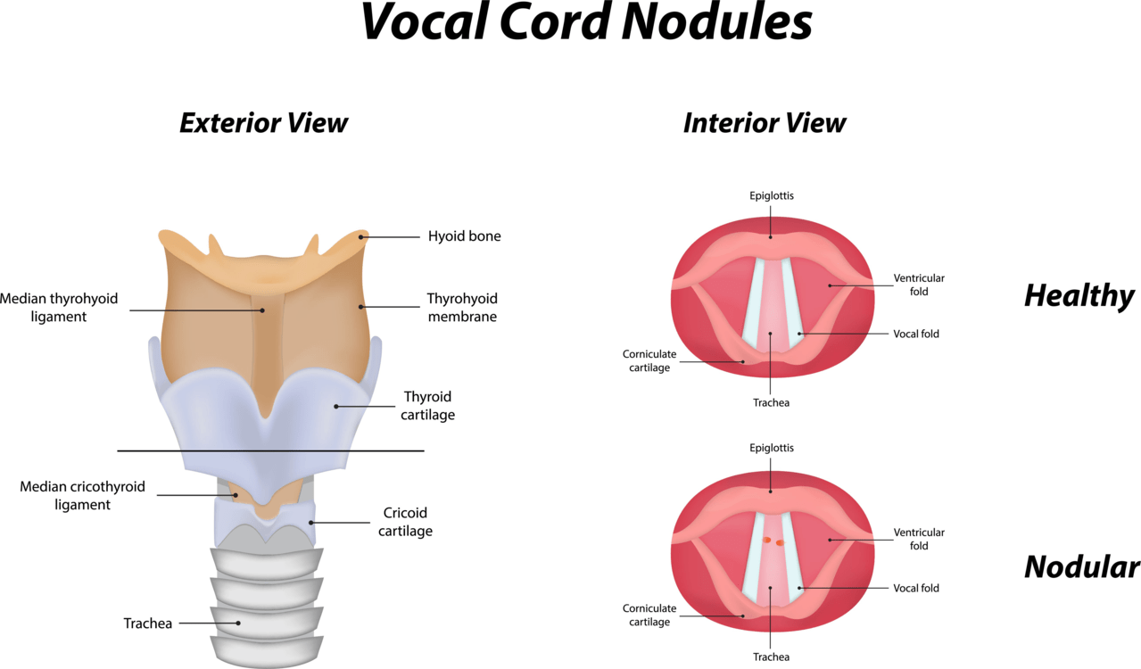 Vocal_Cord_Nodules img