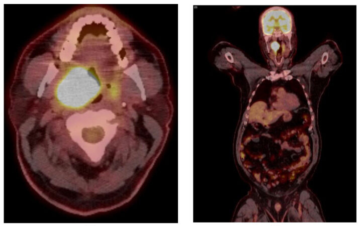 PET scan to detect throat cancer