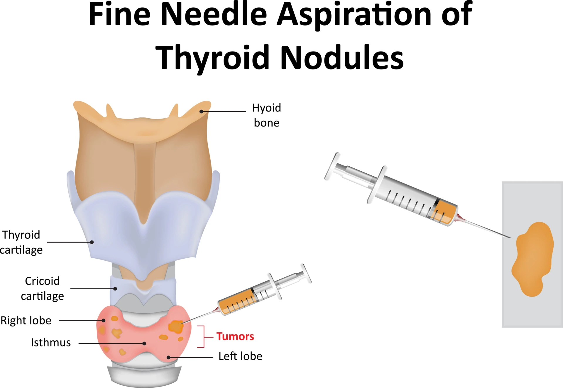 Fine-Needle-Aspiration of Thyroid Nodules Diagram