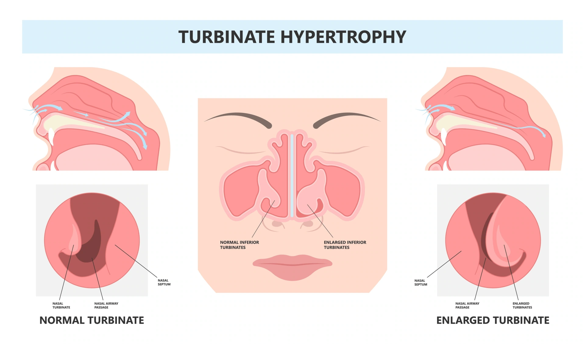 inferior turbinate hypertrophy