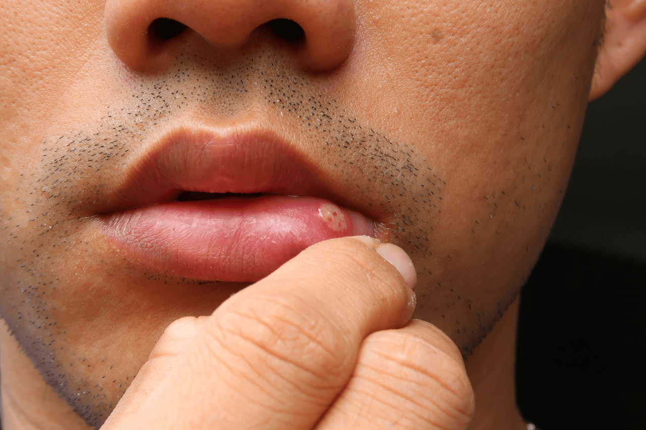 mouth lesions