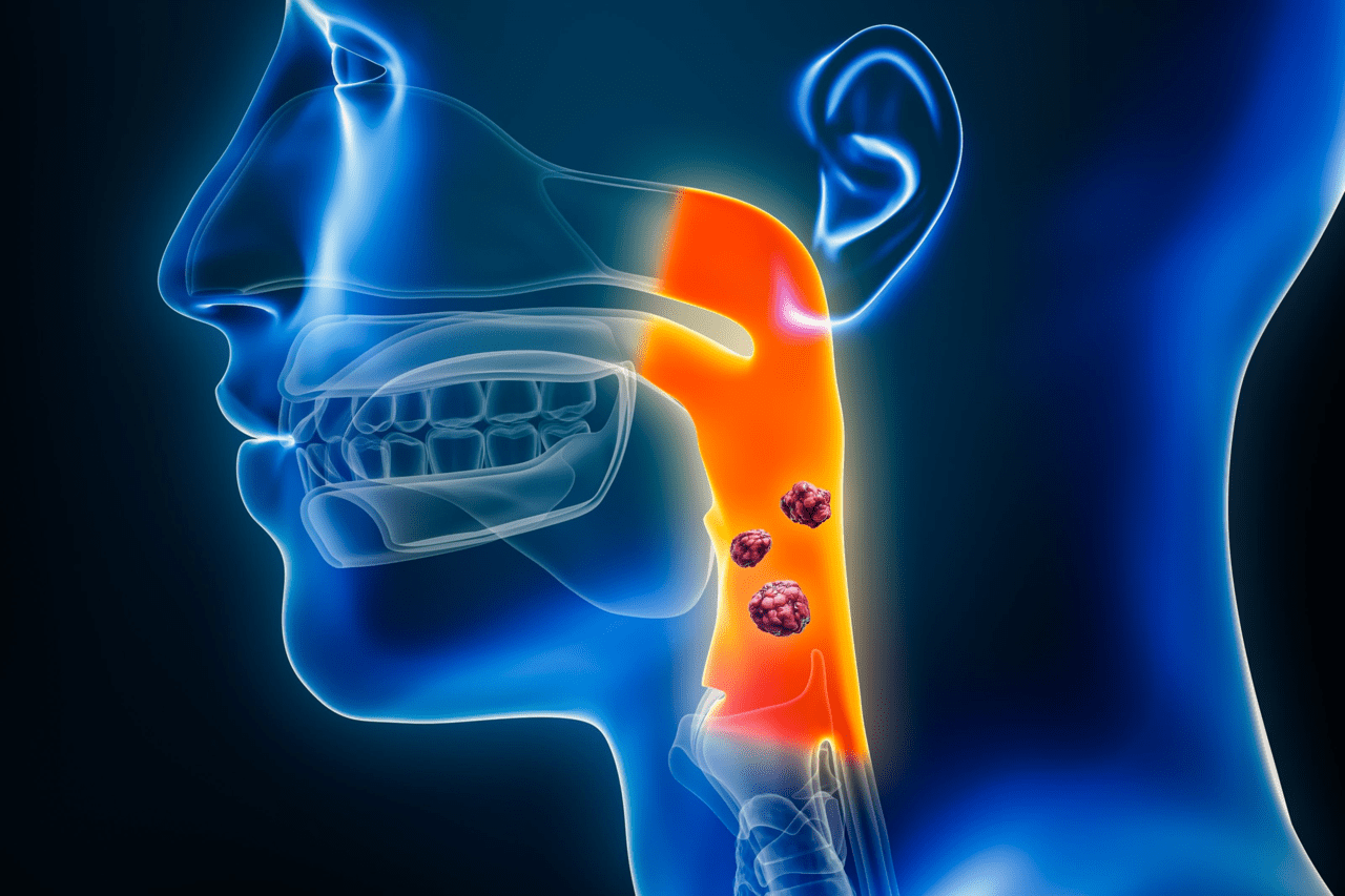 throat cancer