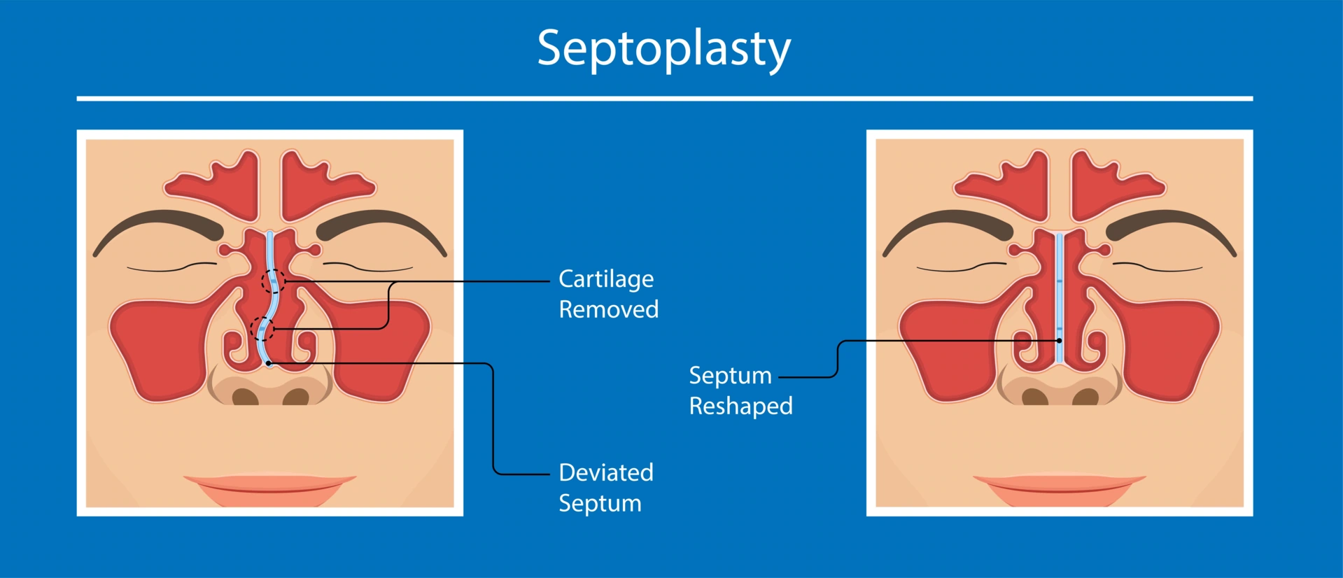 deviated_septum_septoplasty