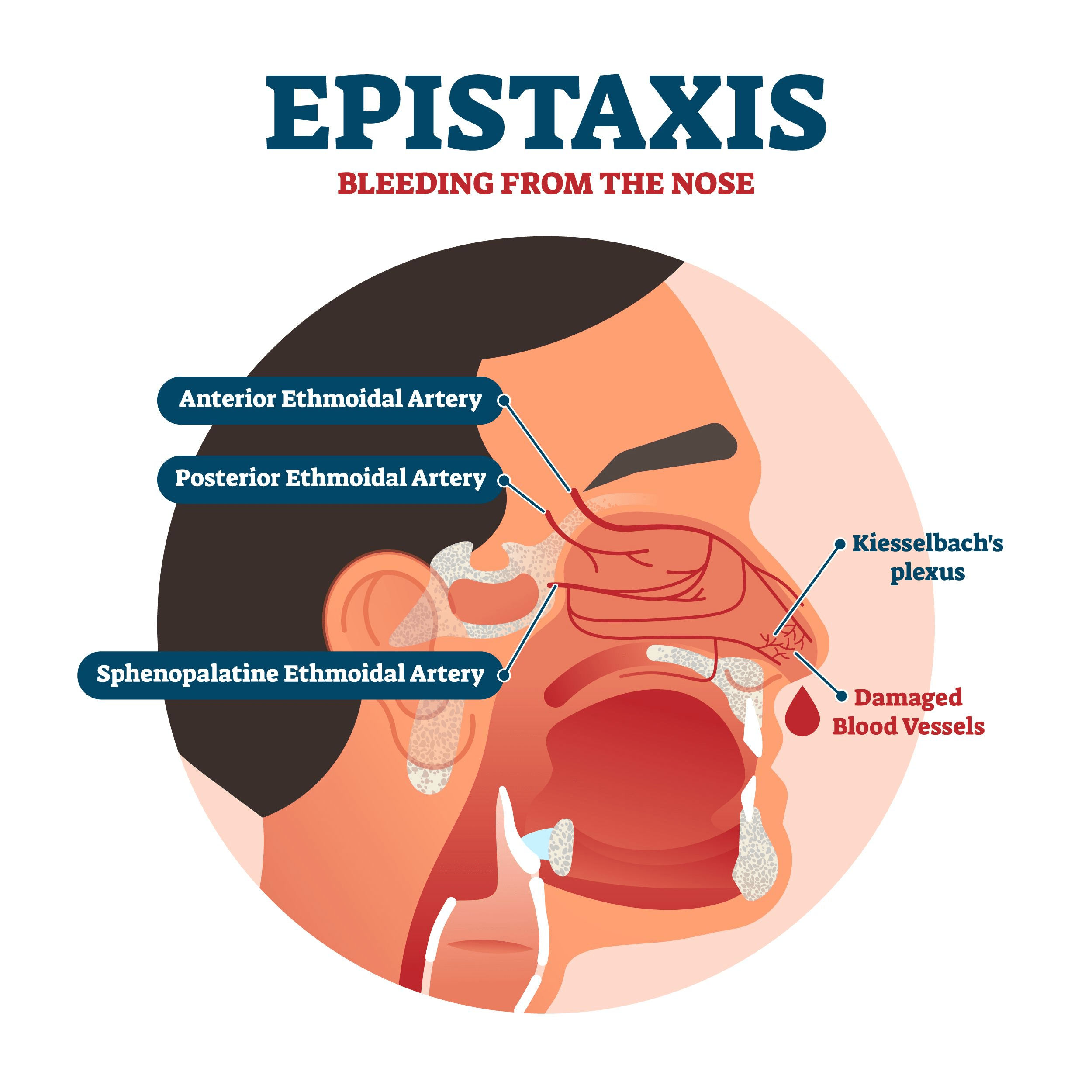epistaxis
