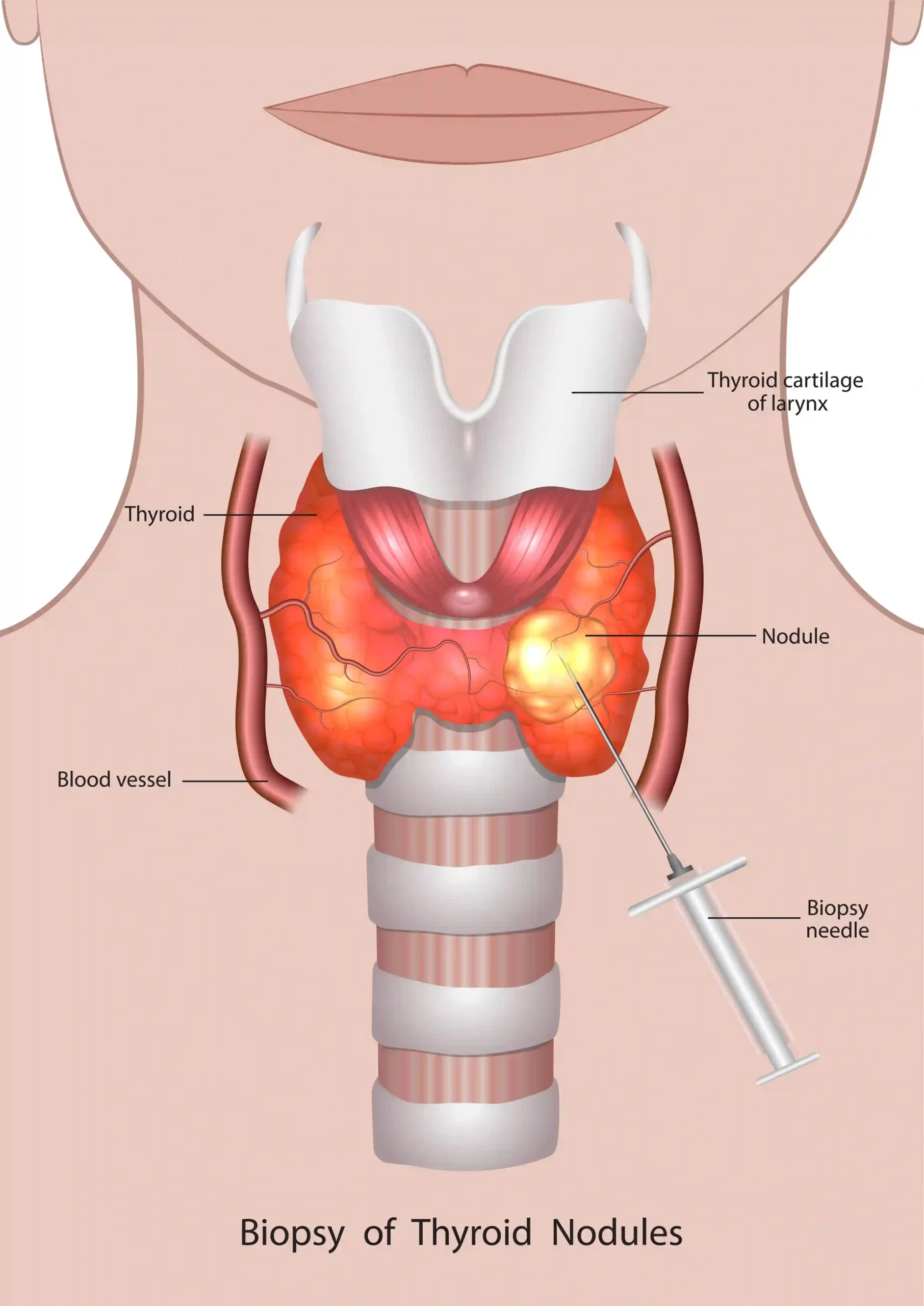 illustration of fine needle biopsy