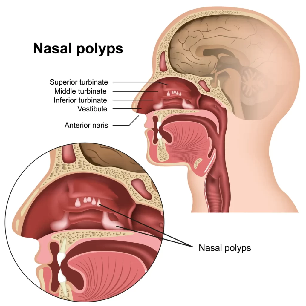 nasal_polyps_img2