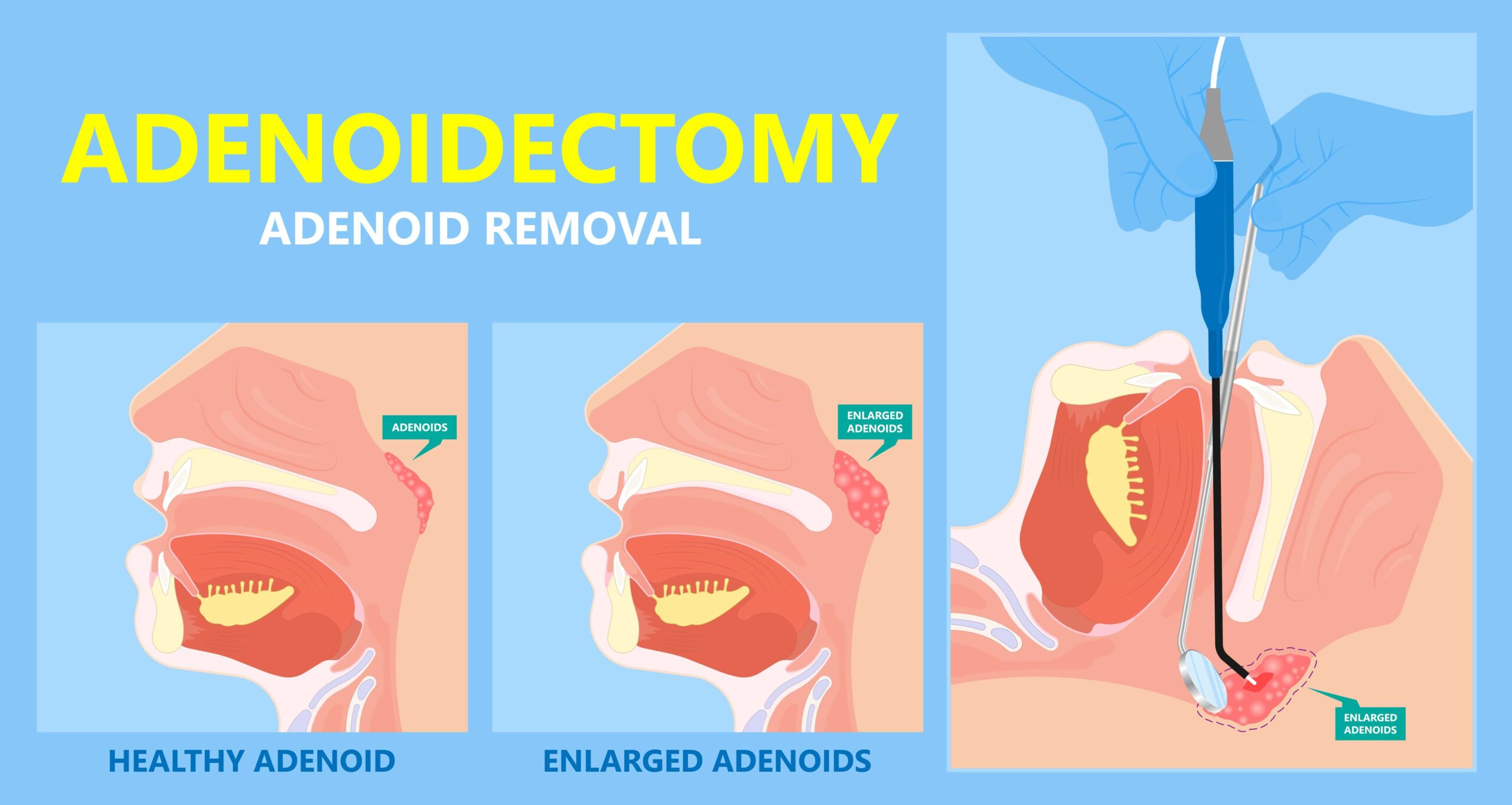 adenoidectomy