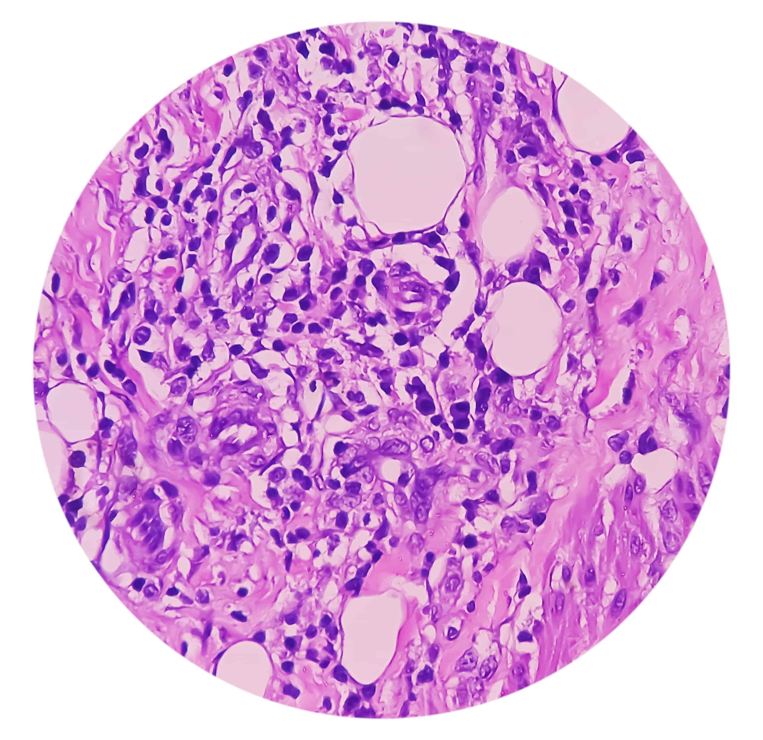 benefits of lymph node biopsy