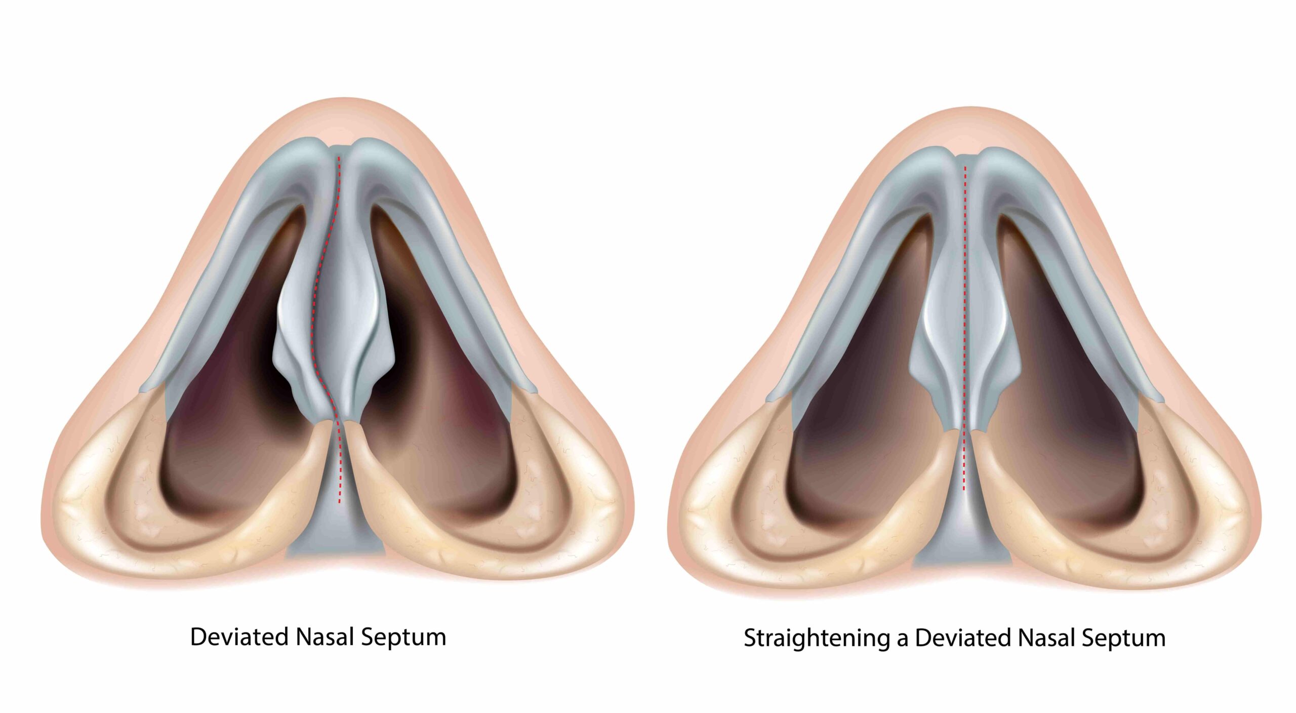 deviated nasal septum