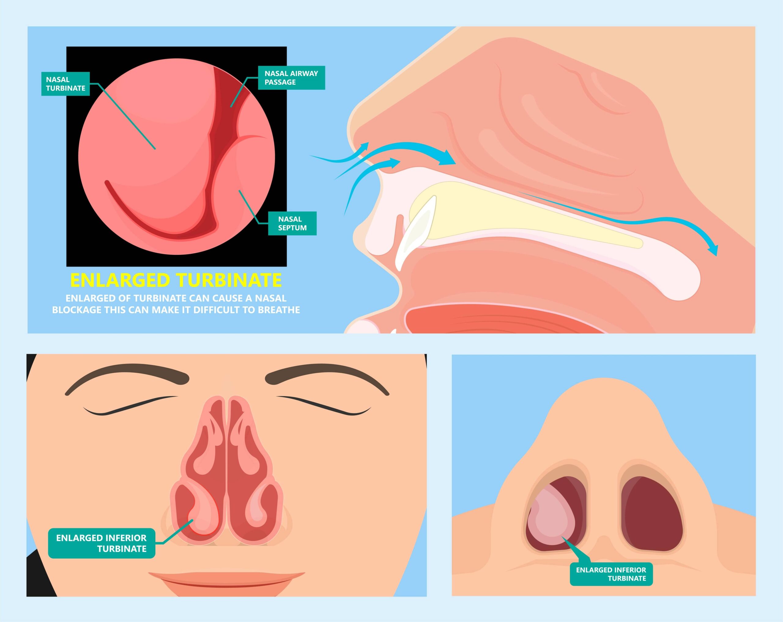 turbinoplasty