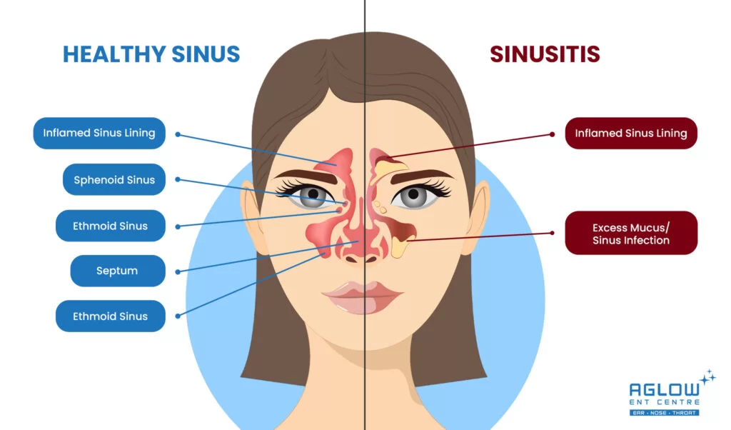 healthy-sinus-sinusitis diagram