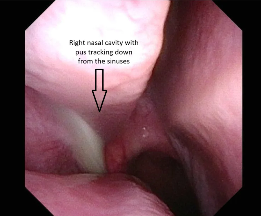 sinusitis with pus in nasal cavity
