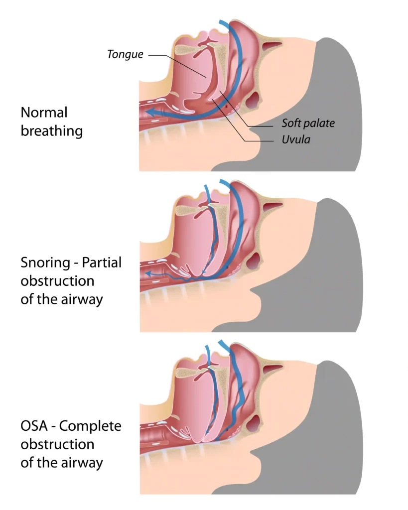 difference between snoring and obstructive sleep apnea