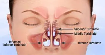 Diagram of enlarged nasal turbinates
