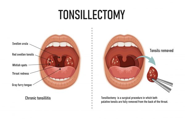 tonsillectomy